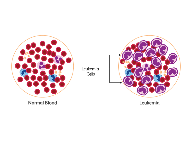 A diagram comparing normal blood composition against one with leukemia cells. A diagram comparing normal blood composition against one with leukemia cells.