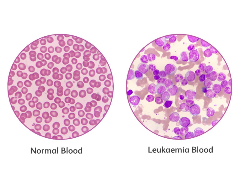 What Is Leukemia Types Of Leukemia Leukemia Causes